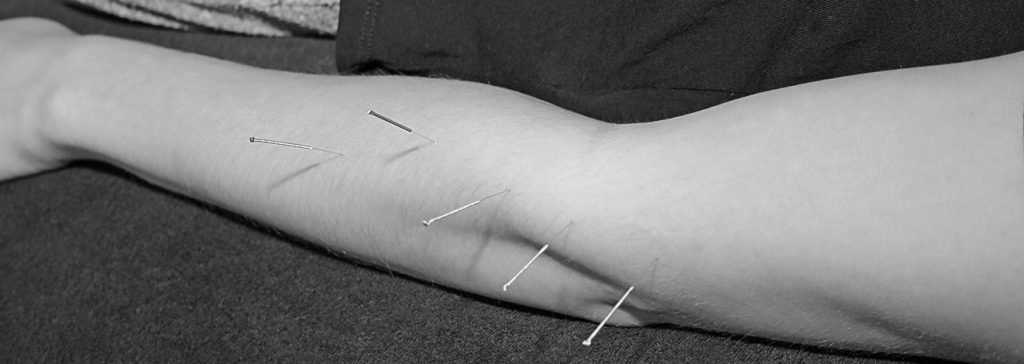 Acupuncture